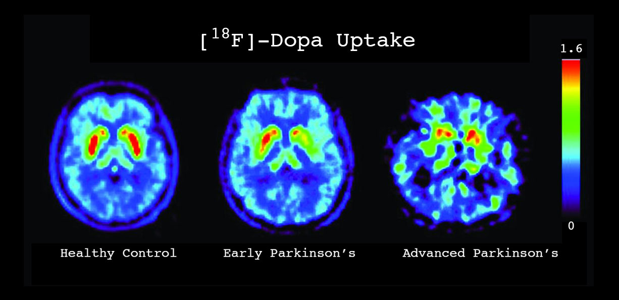 THE DaT SCAN - Does not diagnose Parkinson's · Parkinson's Resource Organization